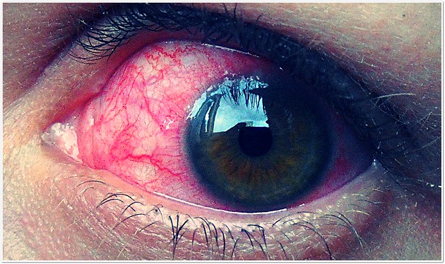 Conjuntivitis